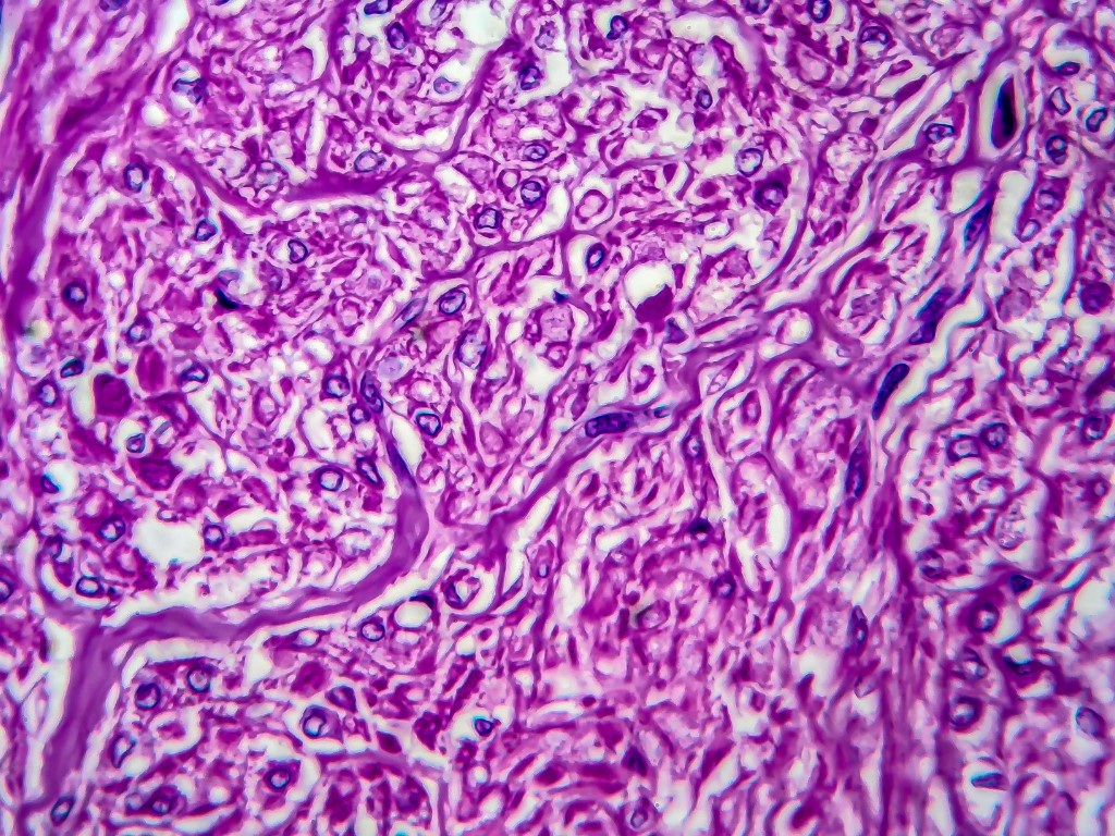 Neuroendocrine tumours of the lung other than SCLC - preview image