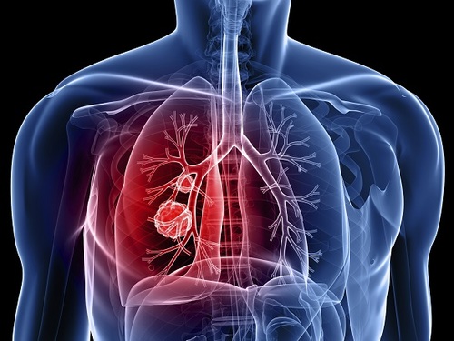 Join us in Milan for the latest in thoracic oncology - preview image