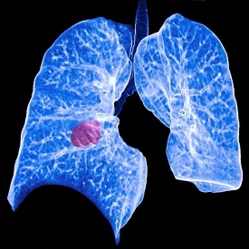 ERS joins Forum of International Respiratory Societies to observe World Lung Cancer Day 2016 - preview image