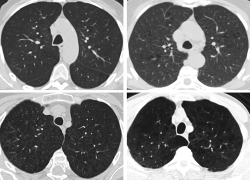 Emphysema is an independent risk factor for non-pulmonary and lung cancer - preview image