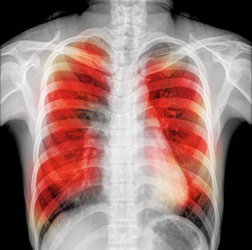 Study finds new mechanism of tuberculosis infection - preview image